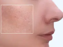 Open Pores